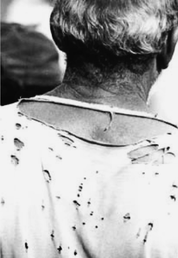 Fotografia em preto e branco das costas da cabeça e dos ombros de uma pessoa idosa com blusa clara manchada.